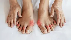Hallux valgus na nohách, opuch a začervenanie kĺbov palcov u dospelého človeka